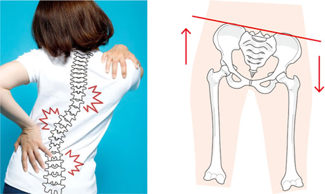 骨盤のゆがみのイメージ