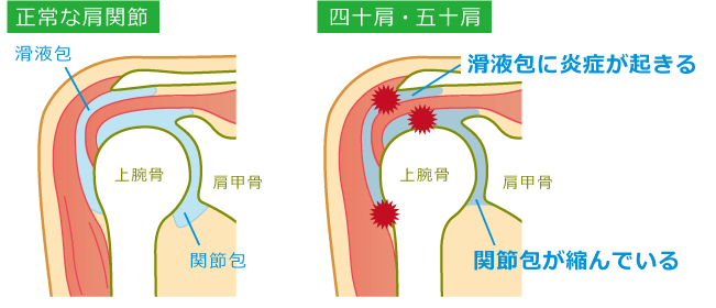 正常な肩関節と、四十肩・五十肩の肩関節